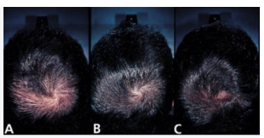 피나스테리드: 전후