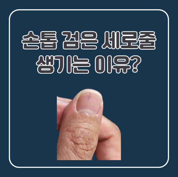 손톱 밑 검은 세로줄 원인