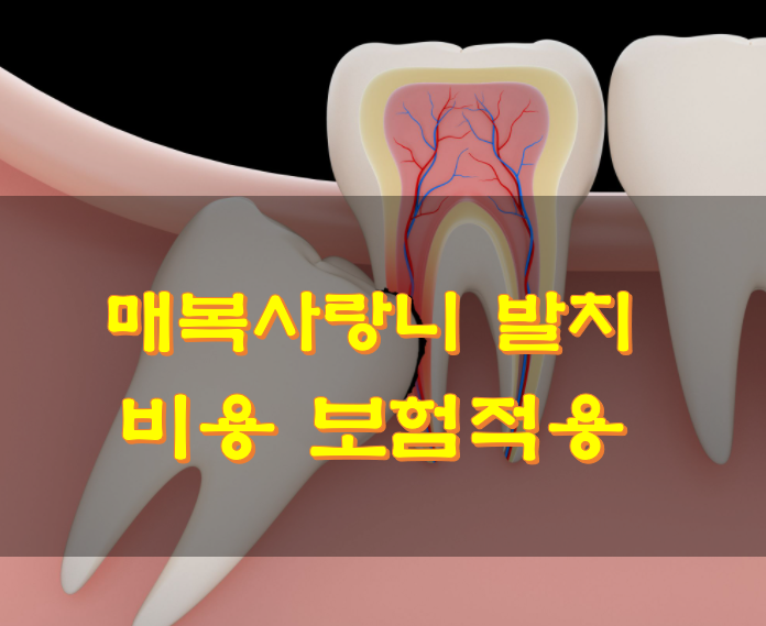 매복 사랑니
