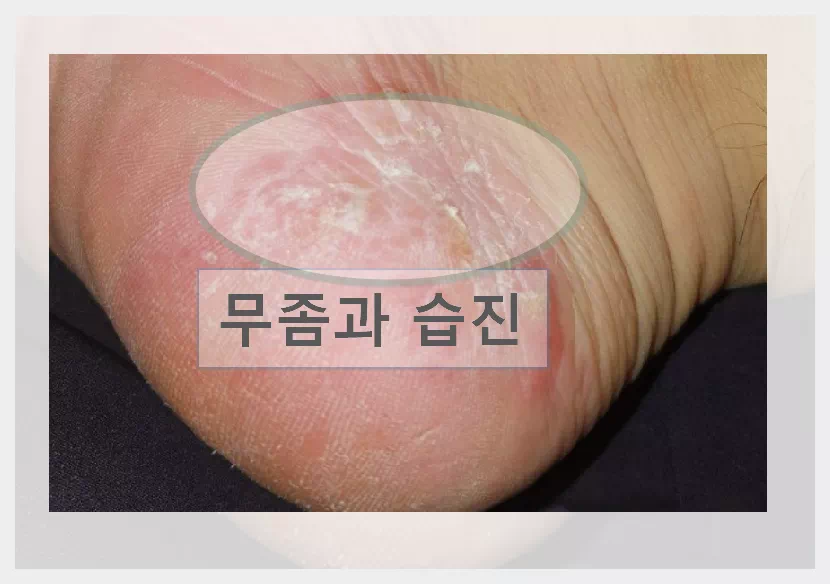 무좀 습진