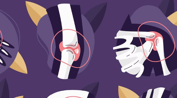 류마티스 관절염 진단