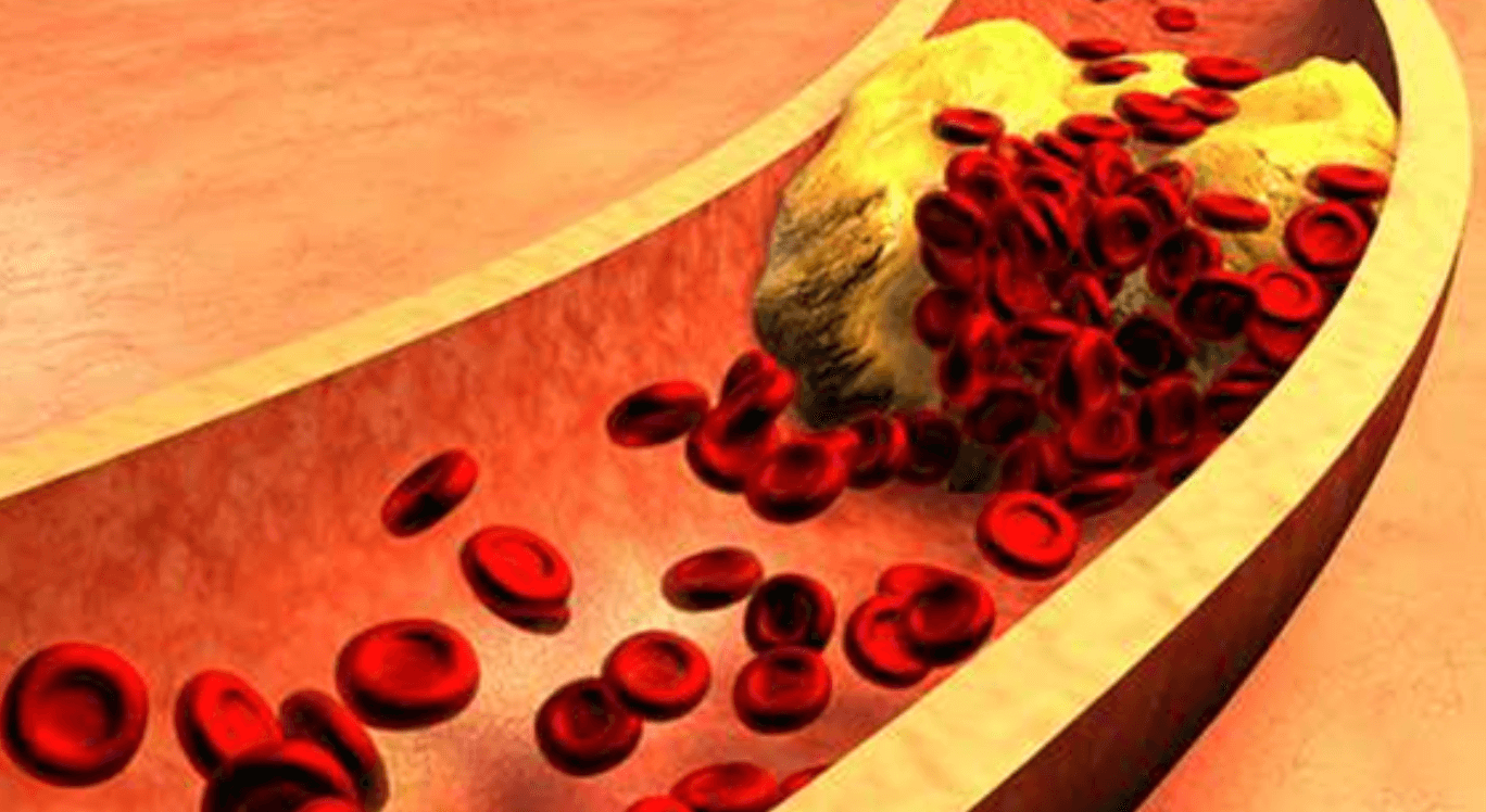 나토키나제 효능