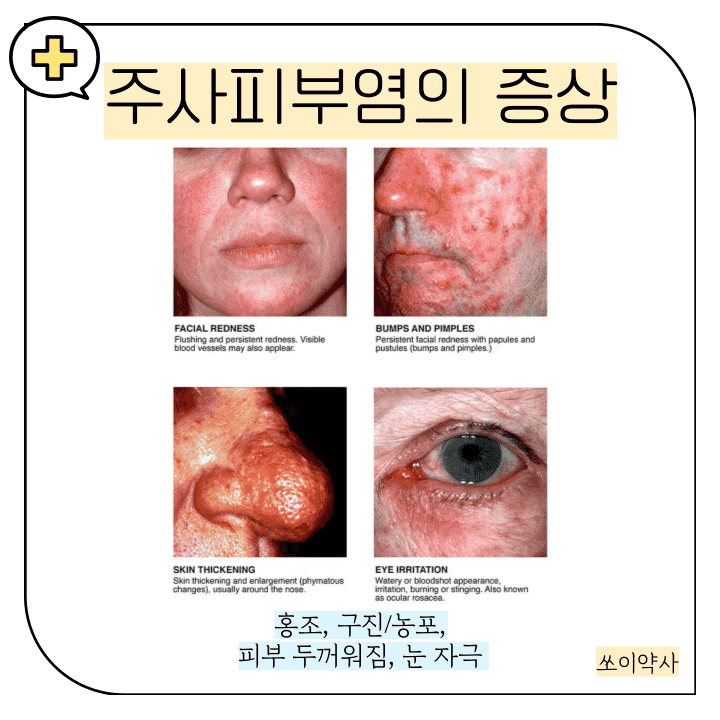 주사피부염 증상