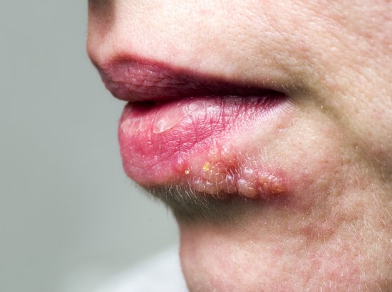 헤르페스(Herpes) – 증상, 원인, 치료 및 예방법