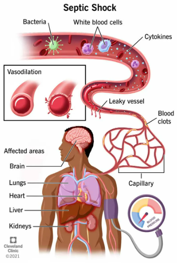 폐혈증이란? 원인 주요증상 치료법 정리
