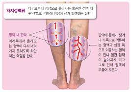 하지정맥류 