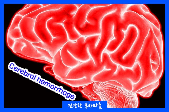 뇌출혈 예방법