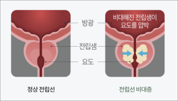 전립선비대증 모식도