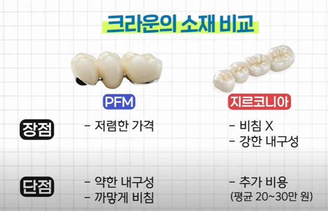 크라운의 소재 비교