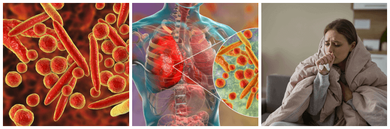 마이코플라즈마 폐렴 관련 사진 3개