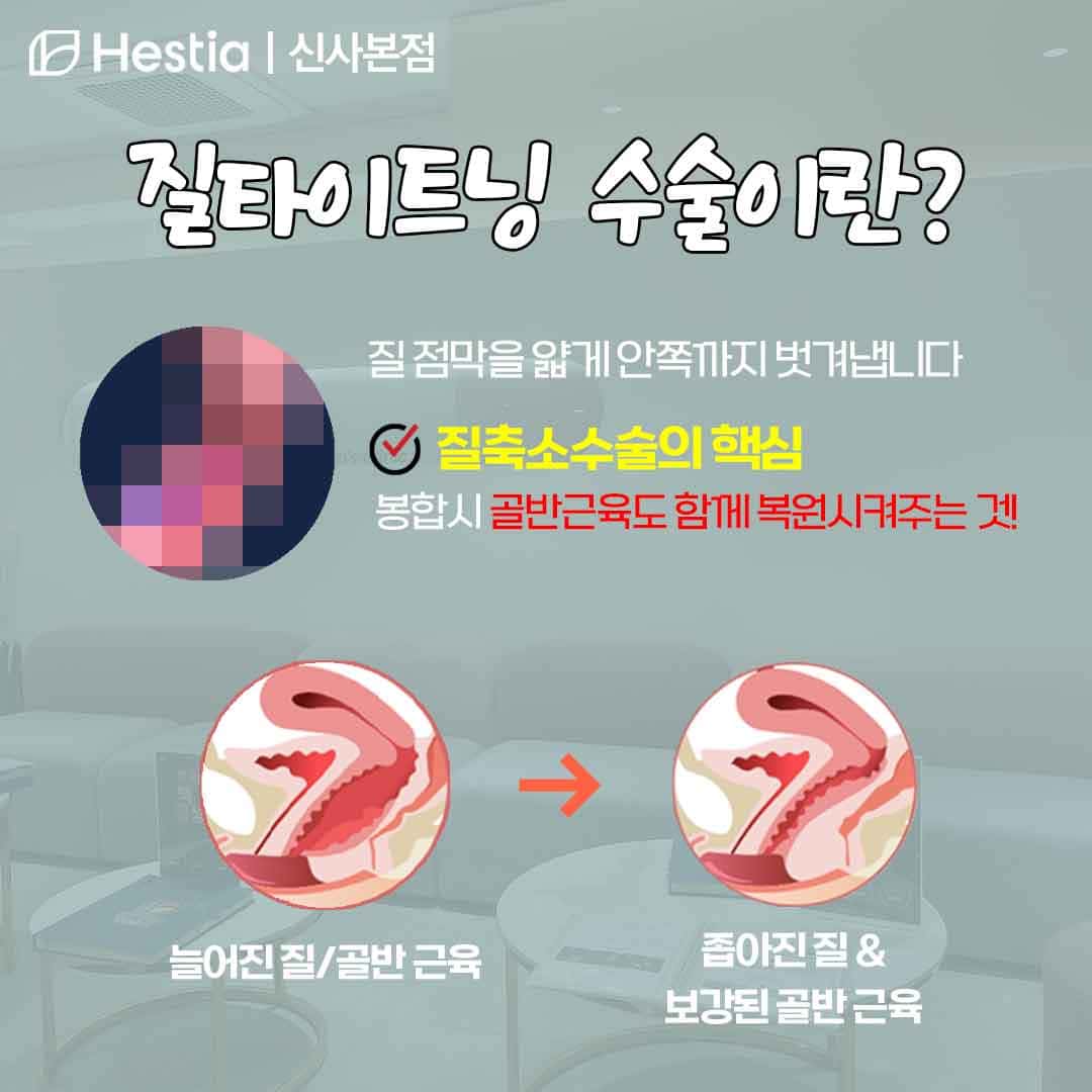 질타이트닝 질방귀 질타이트닝 수술이란?