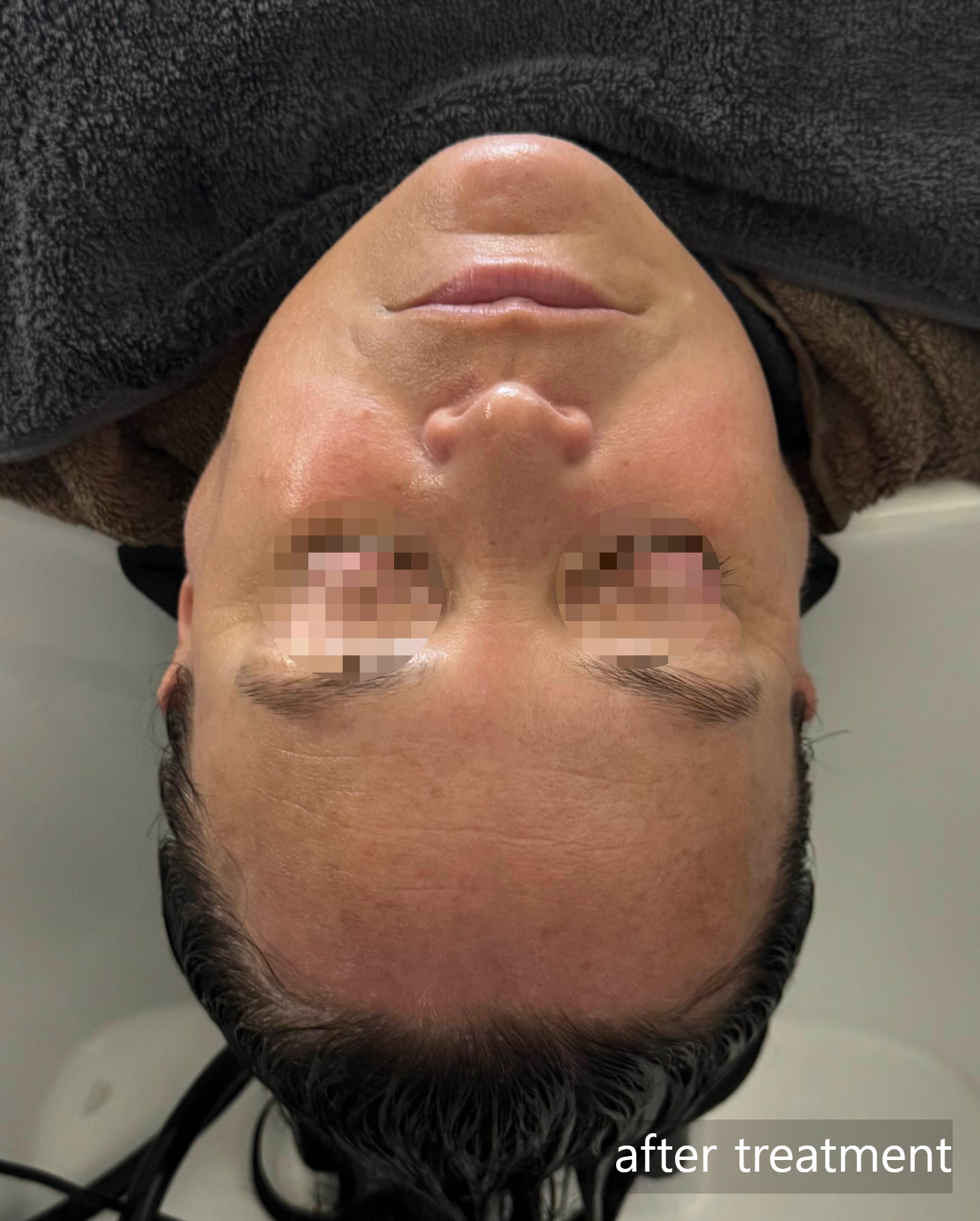 Before and after photos of a calming facial treatment effectively reducing skin redness and facial puffiness. This intensive skin care session is uniquely combined with a professional head spa. Clients experience ultimate relaxation as they receive simultaneous face and scalp treatments while enjoying a continuous full-body massage in a premium recliner chair.
