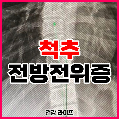 척추 전방전위증