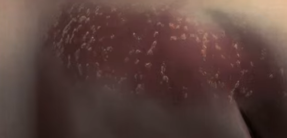 대상포진 초기 증상