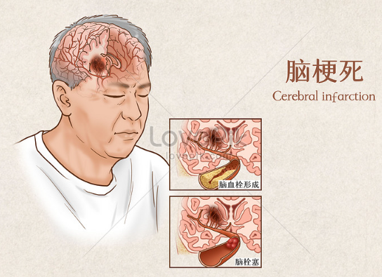 뇌경색 관련사진