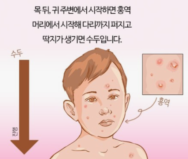 홍역-예방접종