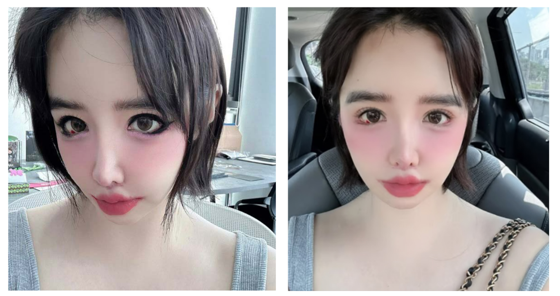 박봄 눈, 뚜렷한 붉은 점