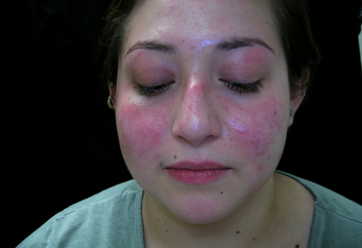 흡수장애형 자가면역질환