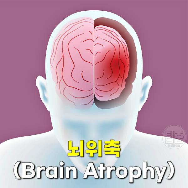 치매 안걸리는 방법 뇌위축 치매예방 혀운동 효과