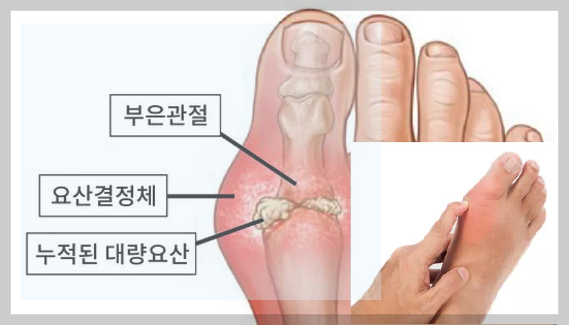 통퐁관절