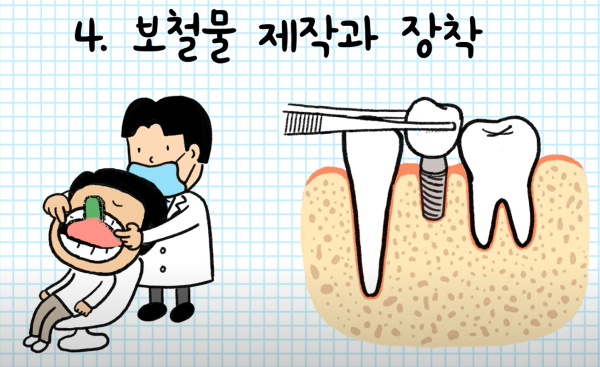 보철물 제작