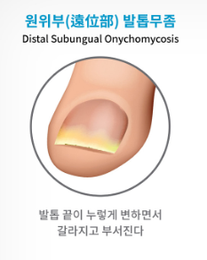 발톱무좀 없애는 방법 2