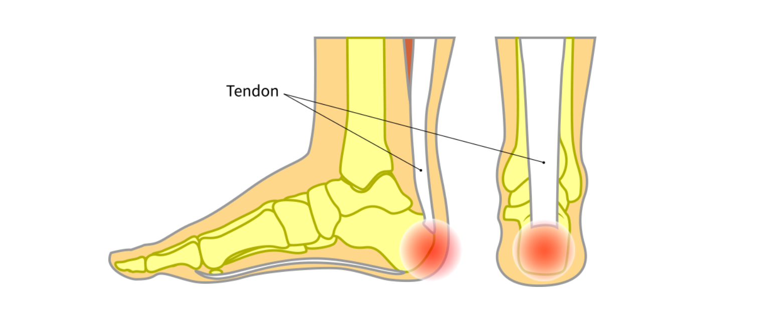 발뒤꿈치 통증 원인