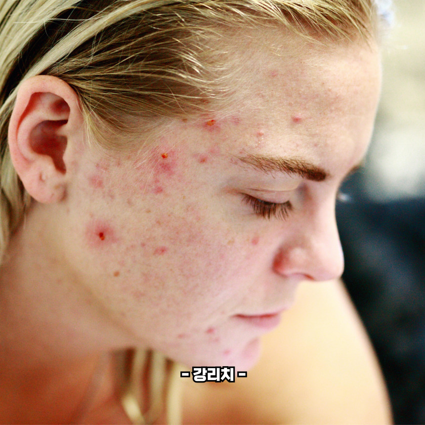 여드름 부위별 원인