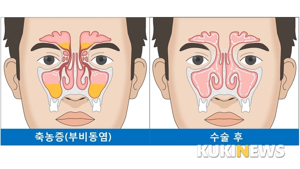 축농증수술