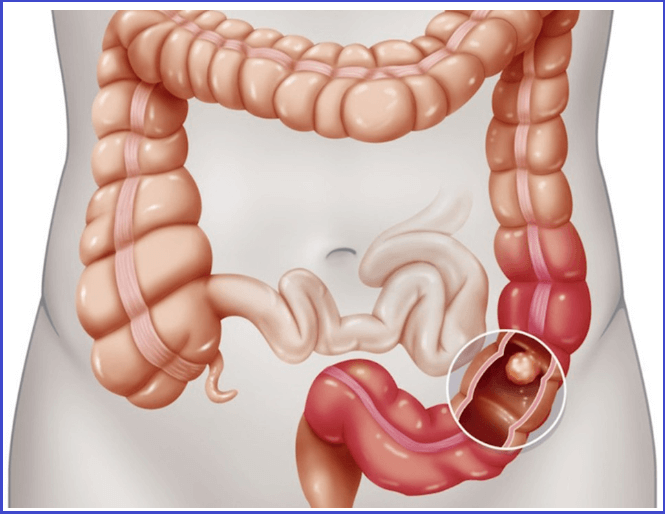 대장암(대변검사)검진-무료-검진기관찾기-조회방법안내