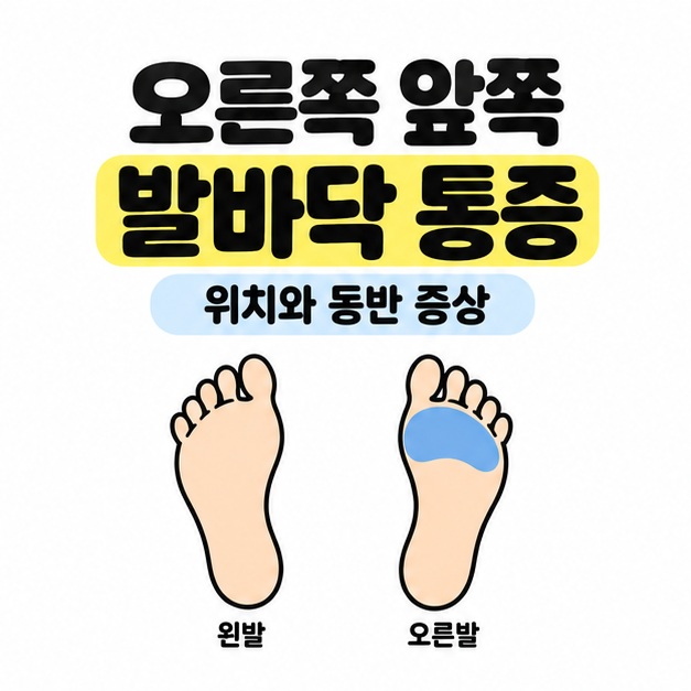 오른쪽 앞쪽 발바닥 통증이라는 제목 아래 좌우 발자국 중 오른발의 발가락 바로 뒤 앞부분을 파란색으로 표시한 그림