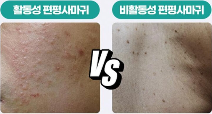 바이러스-활성-비활성-상태(편평사마귀-제거-가격-비용)