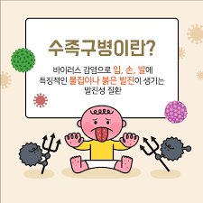2025년 여름 수족구병 급증이유?