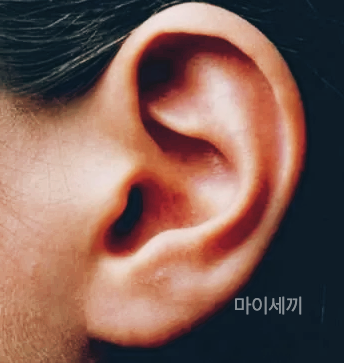 외이도염 자연치유