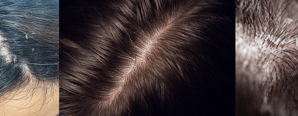 두피 스케일링 비포 에프터