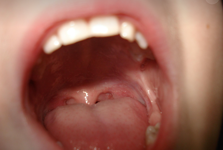 구내염 관련 이미지