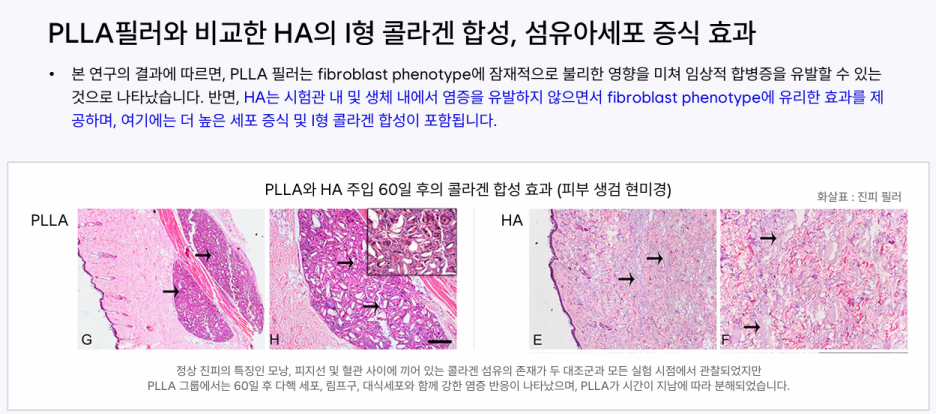 강남역 힐로웨이브 시술 효과