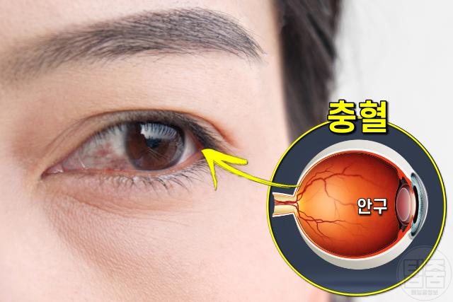 눈 흰자가 빨개요,결막염,눈건조증,팁줌