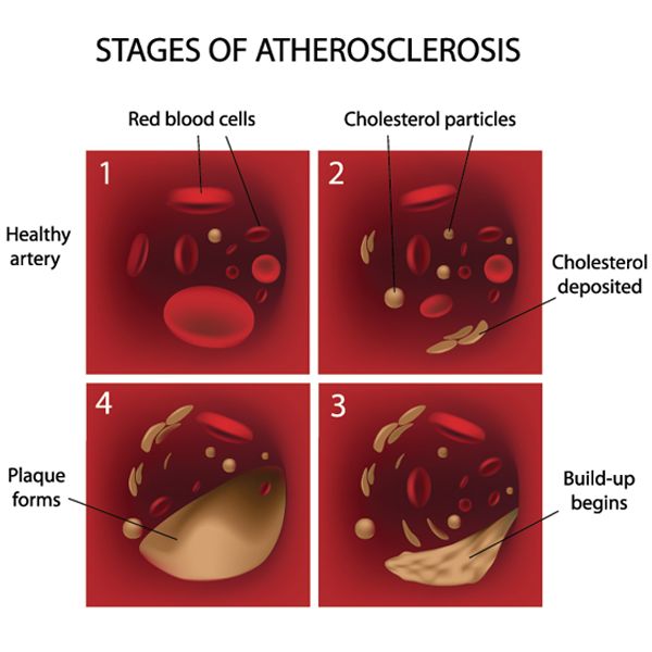 말초동맥 질환 증상