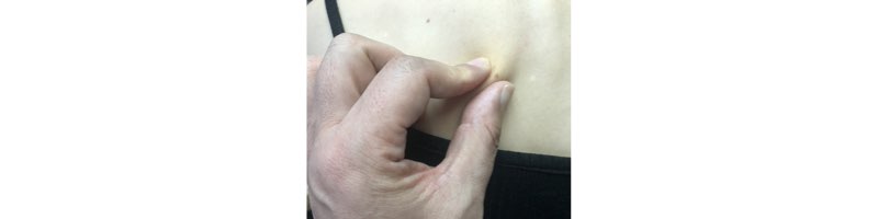 심장 압박감을 호소하는 사람의 등 뒤 기립근 부분의 점이 보여있는 곳을 꼬지기 스도 하는 모습