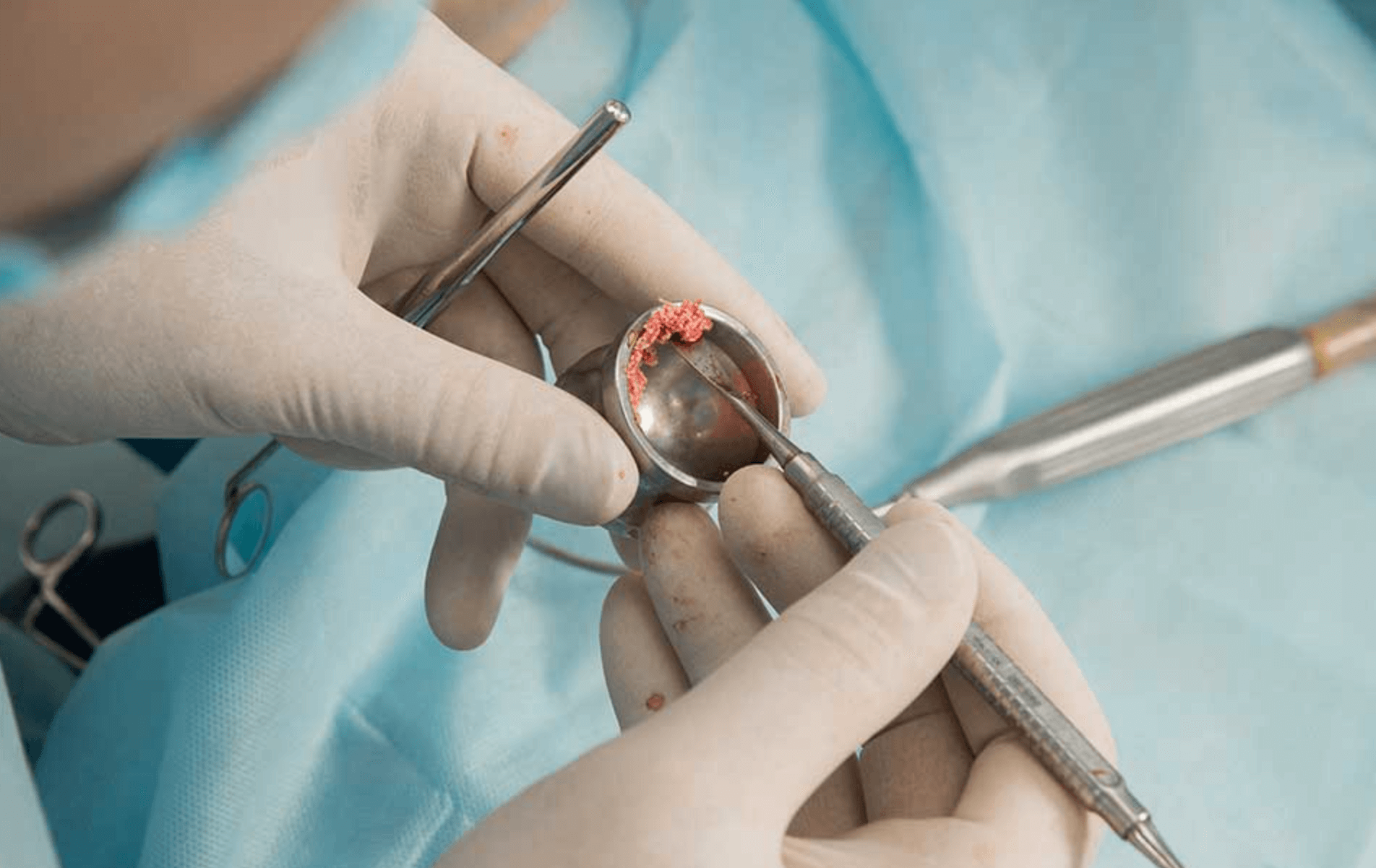 임플란트 뼈이식