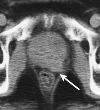 전립선암 초기증상 생존율 원인 수술방법 좋은음식