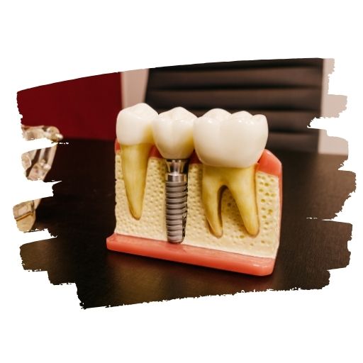 평택 임플란트 잘하는 곳