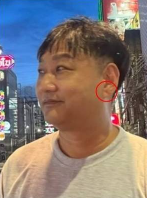 프랭크징후