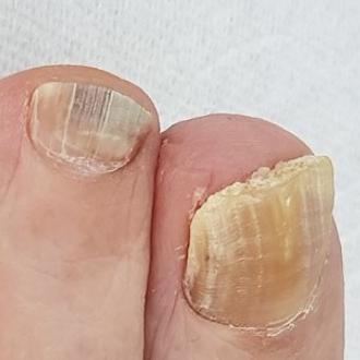 변색되고 두꺼워지는 발톱 무좀
