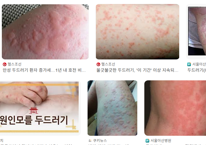 한랭-두드러기