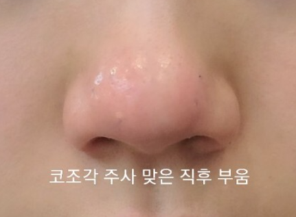 코조각주사 후기