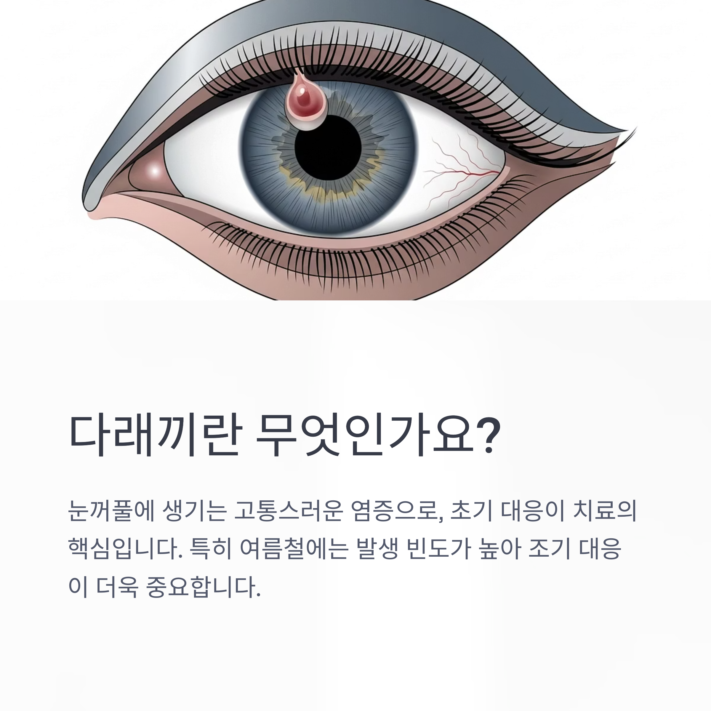 다래끼란 무엇인가요?