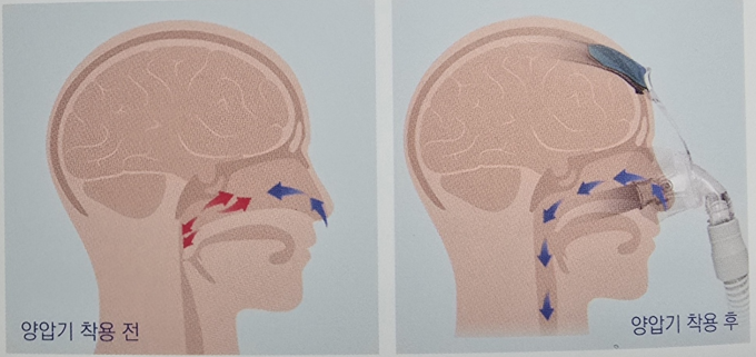 양압기-착용전-착용후-이미지