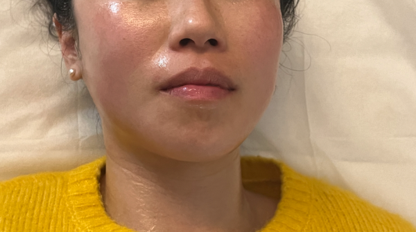 온다 리프팅 후기